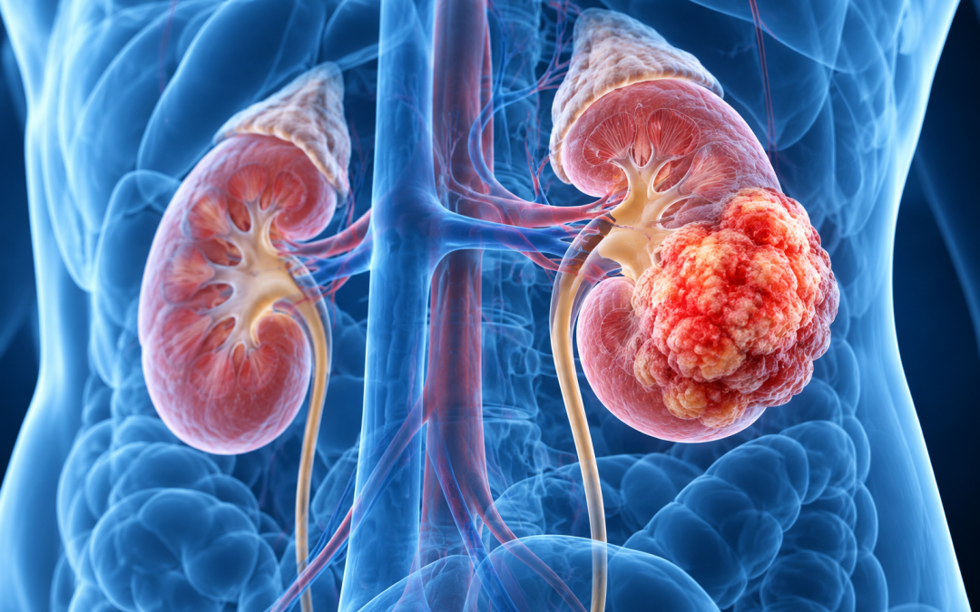 La FDA aprueba belzutifan más lenvatinib para el carcinoma renal avanzado de células claras