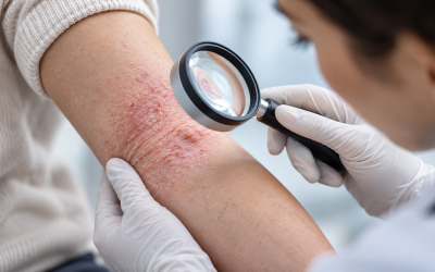 La AAD publica sus primeras recomendaciones sobre pruebas diagnósticas en dermatitis atópica resistente al tratamiento